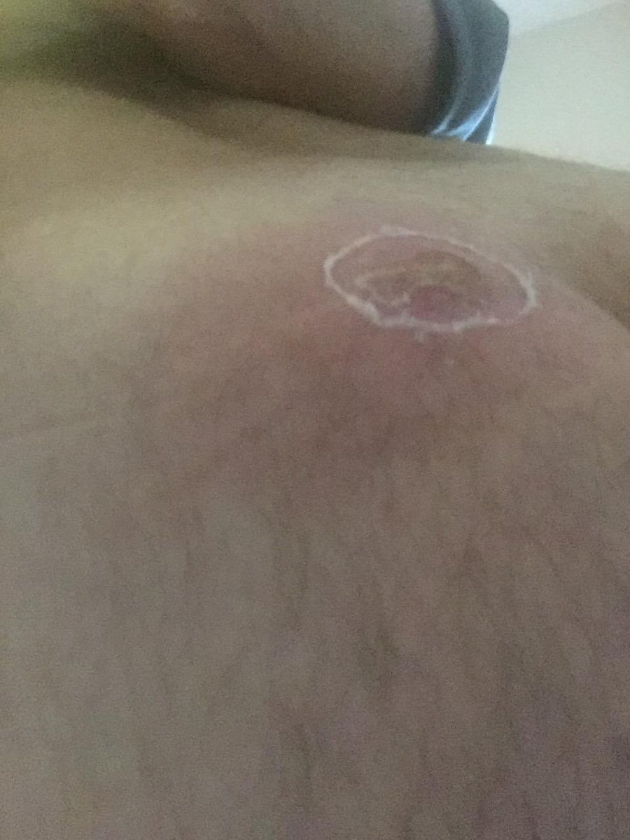 wilddays's tweet photo. @EmiratesSupport Why does no one at emirates seem to care about your terrible customer service?I’ve sent emails,posted messages,terrible experience I had pre Covid which I let go because of the pandemic but now want a response. These are 4 of the 10 bites I had.your ground staff in Manila😡 https://t.co/RKAboyWs6W