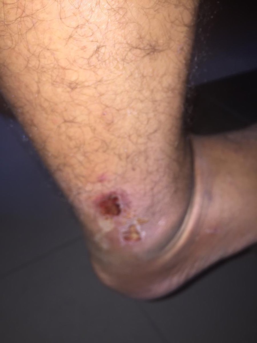 wilddays's tweet photo. @EmiratesSupport Why does no one at emirates seem to care about your terrible customer service?I’ve sent emails,posted messages,terrible experience I had pre Covid which I let go because of the pandemic but now want a response. These are 4 of the 10 bites I had.your ground staff in Manila😡 https://t.co/RKAboyWs6W