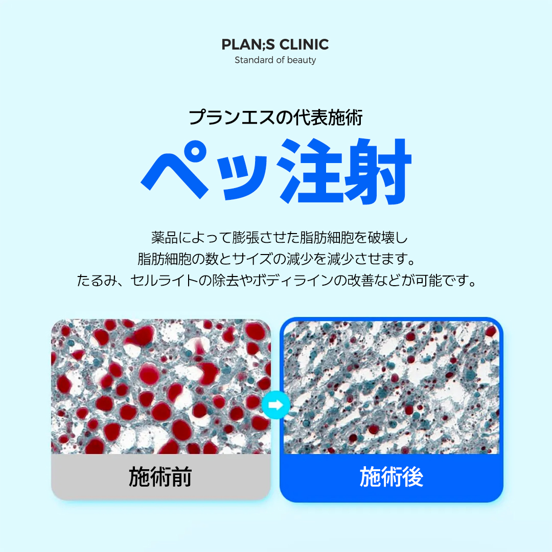 プランエス　脂肪 公式】プランエスクリニック（PLAN;SCLINIC／江南） (@plansjp) / X