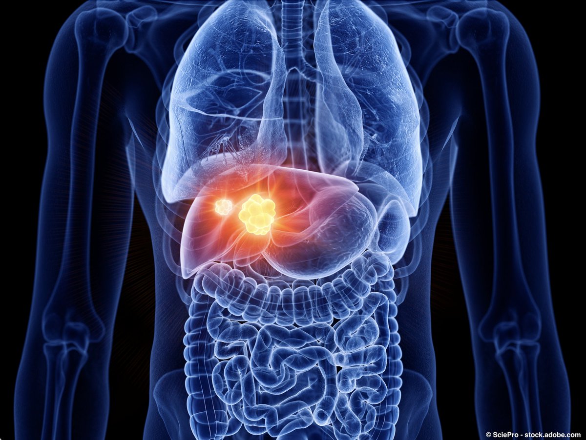 OncLive's tweet image. Nab-paclitaxel + gemcitabine/cisplatin did not produce a statistically significant difference in OS and PFS outcomes vs gemcitabine/cisplatin alone in patients with newly diagnosed advanced biliary tract cancer.
@rachnatshroff @UAZCancer #hpbcsm #oncology
hubs.ly/Q037sXTX0