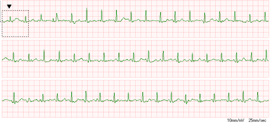 Got myself a new toy - Prince 180B ECG Monitor. I need to get leads for it, but should be even better then.

#ECG #EKG #cardiophile