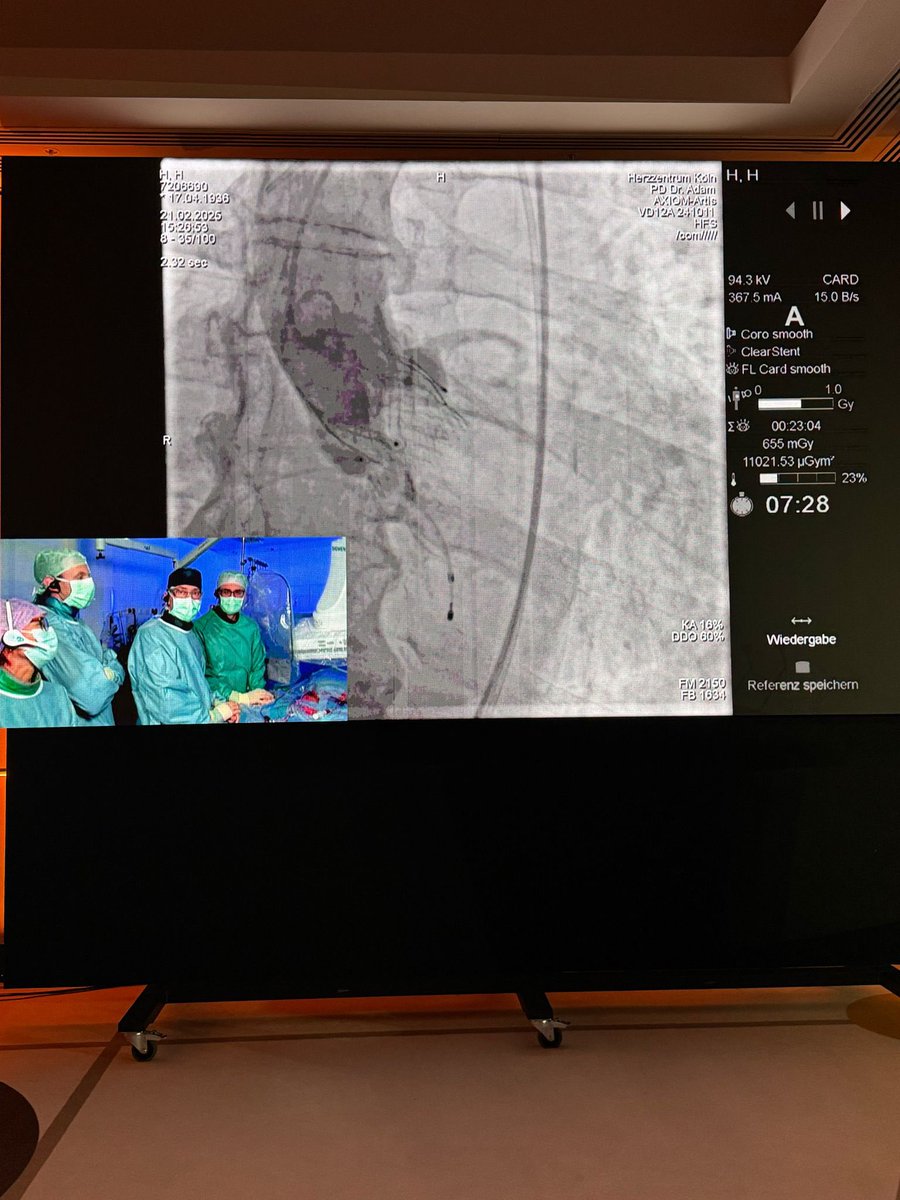 Jonathan Curio (@curiojonathan) on Twitter photo #AorticRegurgitation as new #TAVI frontier: <a href="/JenaValve/">JenaValve Technology</a> #livecase by Matti Adam <a href="/UKKoeln/">Uniklinik Köln</a> at #JIMGISE2025 <a href="/jimcongress/">JIM Congress</a>⭐️
🎯dedicated device with mechanism clipping to the leaflets
🎯by design commissuraly aligned + not calcium dependent
➡️RCTs vs low/interm risk surgery ongoing #AorticRegurgitation as new #TAVI frontier: <a href="/JenaValve/">JenaValve Technology</a> #livecase by Matti Adam <a href="/UKKoeln/">Uniklinik Köln</a> at #JIMGISE2025 <a href="/jimcongress/">JIM Congress</a>⭐️
🎯dedicated device with mechanism clipping to the leaflets
🎯by design commissuraly aligned + not calcium dependent
➡️RCTs vs low/interm risk surgery ongoing