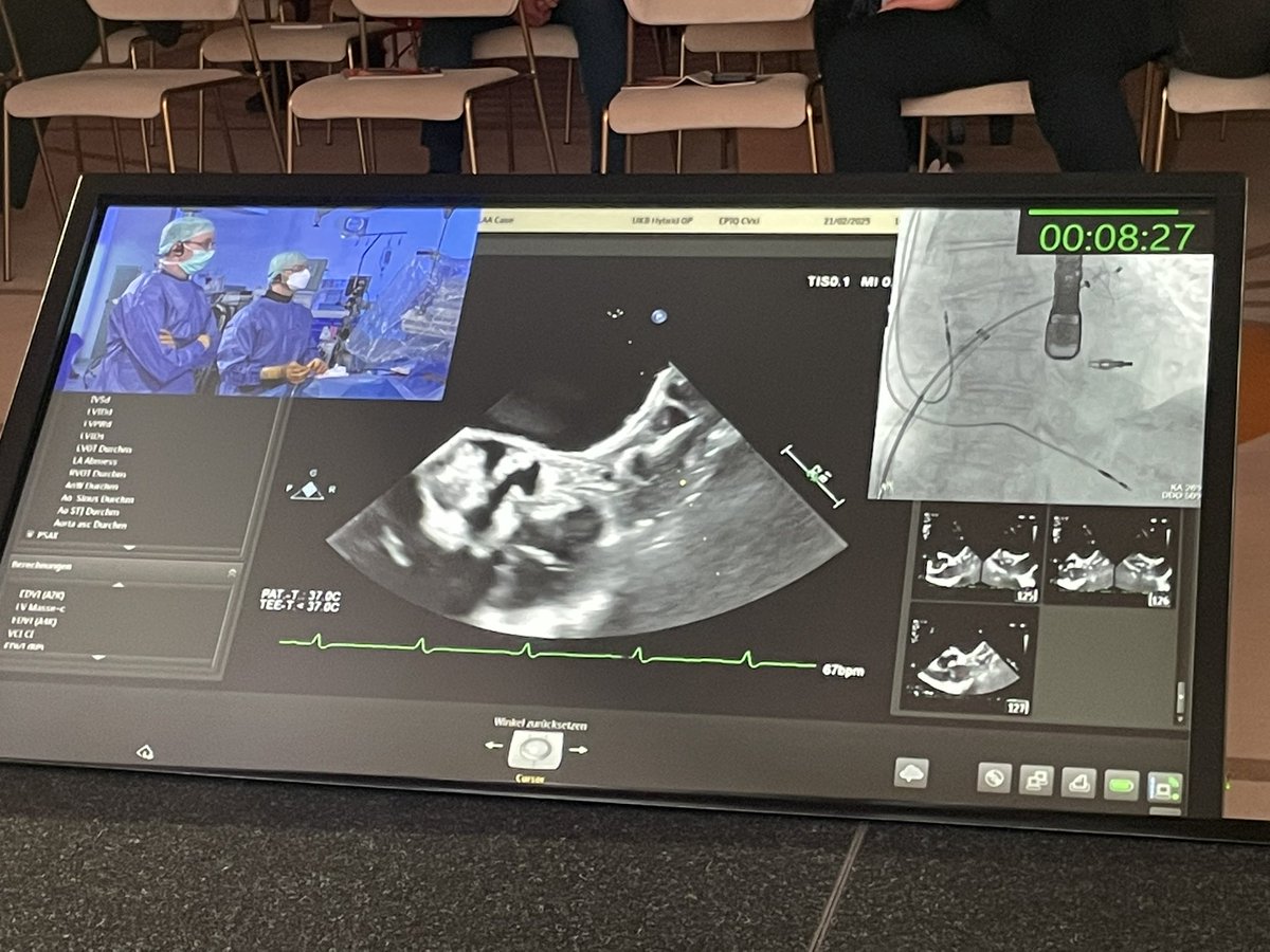 Jonathan Curio (@curiojonathan) on Twitter photo LAAO + M-TEER combo as #livecase from <a href="/UniklinikBonn/">Uniklinik Bonn</a> at #JIMGISE2025 <a href="/jimcongress/">JIM Congress</a> ⭐️
🎯puncture height chosen for good clipping, LAAO will work/follow by steering
🎯TEER first then LAAO
➡️combo safe & doable in reasonable amount of time LAAO + M-TEER combo as #livecase from <a href="/UniklinikBonn/">Uniklinik Bonn</a> at #JIMGISE2025 <a href="/jimcongress/">JIM Congress</a> ⭐️
🎯puncture height chosen for good clipping, LAAO will work/follow by steering
🎯TEER first then LAAO
➡️combo safe & doable in reasonable amount of time