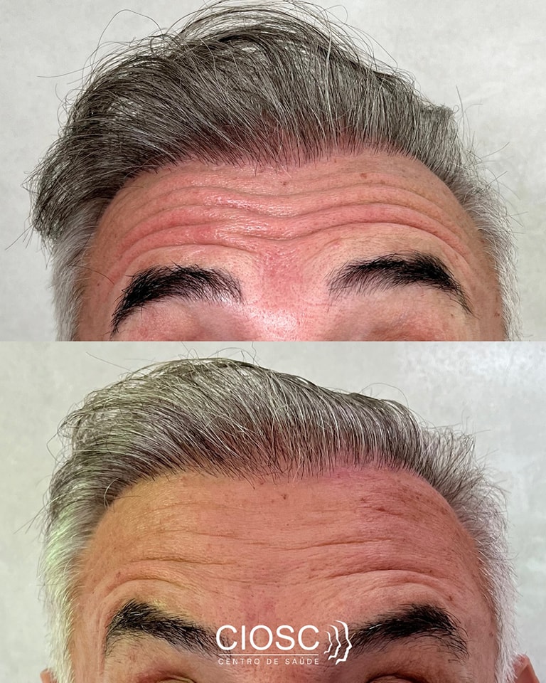 CIOSCSC's tweet photo. Rugas? Marcas de expressão? O Botox pode ser a solução!

A toxina botulínica suaviza linhas, previne rugas e realça sua beleza de forma natural. Veja o antes e depois desse procedimento incrível!

#BotoxFlorianópolis #ToxinaBotulínica #Rejuvenescimento #Estética #SulDaIlha https://t.co/3FXcj2qcLx