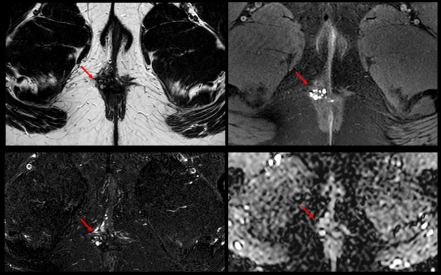 ESGAR (@esgarsociety) on Twitter photo 💥 New YE case. Courtesy of Dr. Canales, submitted by <a href="/AnaVillanuevaCa/">Ana Villanueva</a>
♀️ 27 yo. Perianal pain of 2 years, recently admitted to ED with diagnosis of perianal abscess
🔴 Multilocular hyperintense T2 lesion, hyperintense on T1 fat sat and not restricted difussion
🧵.. 💥 New YE case. Courtesy of Dr. Canales, submitted by <a href="/AnaVillanuevaCa/">Ana Villanueva</a>
♀️ 27 yo. Perianal pain of 2 years, recently admitted to ED with diagnosis of perianal abscess
🔴 Multilocular hyperintense T2 lesion, hyperintense on T1 fat sat and not restricted difussion
🧵..