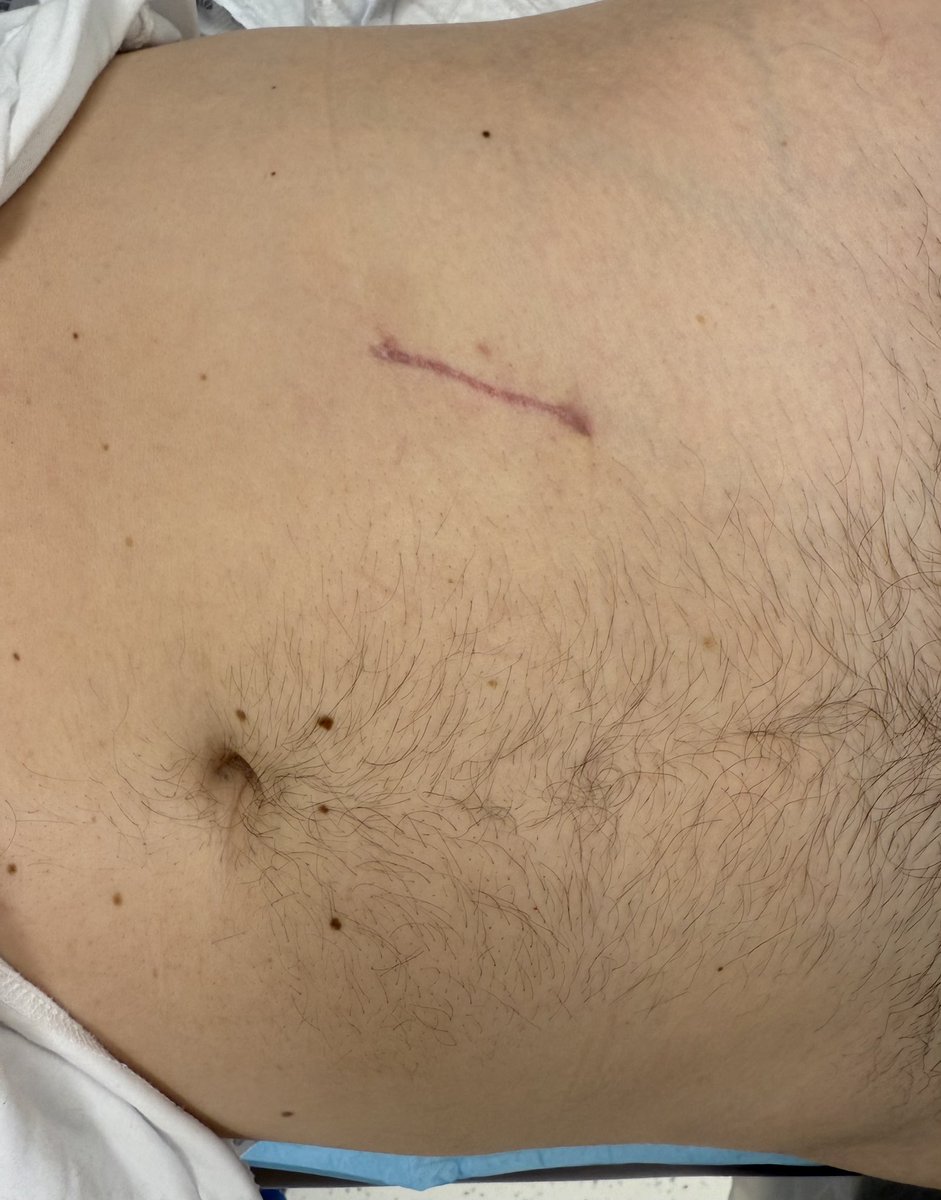 Delighted to share our <a href="/HCAHospitalsUK/">HCA Healthcare UK</a> London Bridge early Single Port data. Over 260 cases in 9 months since April 2024. Patient benefits for prostate and kidney surgery. Smaller scars. Less pain. Same outcomes. <a href="/chriseden99/">Christopher Eden</a> Declan Cahill <a href="/nairajesh/">Rajesh Nair</a>