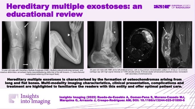 Alvaro Rueda (@alvaror96) on Twitter photo Fresh out of the oven! Here is our work on Hereditary Multiple Exostoses, published in <a href="/InsightsImaging/">Insights into Imaging</a> #OpenAccess insightsimaging.springeropen.com/articles/10.11… <a href="/sagompe/">Sara Gomez</a> <a href="/AnaCrespo_RX/">Ana Crespo</a> Fresh out of the oven! Here is our work on Hereditary Multiple Exostoses, published in <a href="/InsightsImaging/">Insights into Imaging</a> #OpenAccess insightsimaging.springeropen.com/articles/10.11… <a href="/sagompe/">Sara Gomez</a> <a href="/AnaCrespo_RX/">Ana Crespo</a>