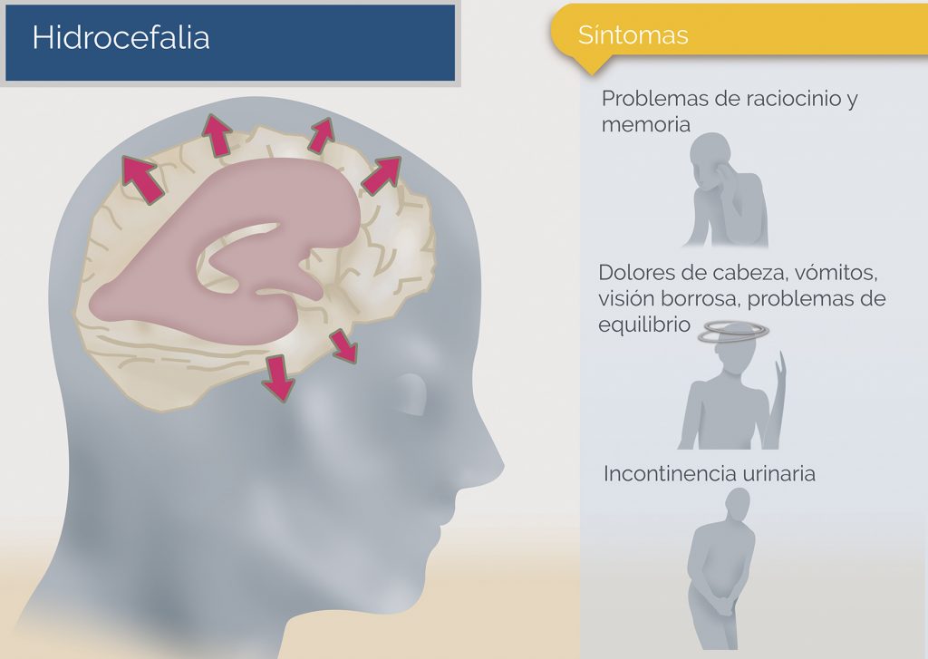 La hidrocefalia puede provocar:
🔹 Aumento del tamaño de la cabeza en bebés
🔹 Problemas de memoria o confusión en adultos mayores
🔹 Dificultad para caminar o pérdida de equilibrio
En muchos casos, un drenaje adecuado con válvulas de derivación puede mejorar la calidad de vida.