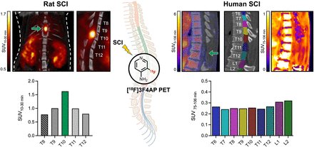 SpectronRx's tweet image. A cutting-edge PET radiotracer, 18F-3F4AP, is shining new light on how healthcare professionals assess spinal cord injuries. Read the complete study here: jnm.snmjournals.org/content/66/2/2…

#NuclearMedicine #SpinalCordResearch #Neurology #MolecularImaging