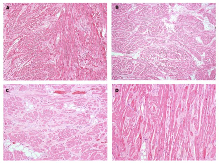 Beyond the postmortem diagnosis of hypertrophic cardiomyopathy: a genetic approach guided by clinical and morphological features in Noonan syndrome. <a href="/RevEspCardiol/">REC Publications</a> 

👉🏻 revespcardiol.org/en-beyond-the-…