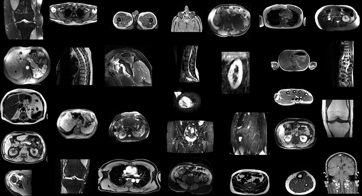 Radiology (@radiology_rsna) on Twitter photo TotalSegmentator MRI is an open-source tool for automatic, sequence-independent segmentations of major anatomic structures at MRI. See how it performed in this study! <a href="/UniSpitalBasel/">UniSpitalBaselCH</a> <a href="/UniBasel_en/">University of Basel</a> <a href="/Tugba_Akinci_MD/">Tugba Akinci D'Antonoli</a> <a href="/JakobWasserthal/">Jakob Wasserthal</a> bit.ly/4hLUInk TotalSegmentator MRI is an open-source tool for automatic, sequence-independent segmentations of major anatomic structures at MRI. See how it performed in this study! <a href="/UniSpitalBasel/">UniSpitalBaselCH</a> <a href="/UniBasel_en/">University of Basel</a> <a href="/Tugba_Akinci_MD/">Tugba Akinci D'Antonoli</a> <a href="/JakobWasserthal/">Jakob Wasserthal</a> bit.ly/4hLUInk