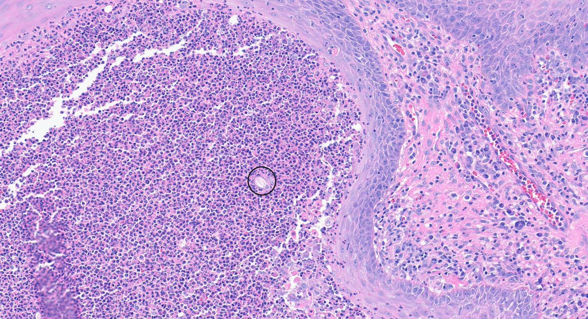 Henry YANG (@henryy_md) on Twitter photo PEH (pseudoepithelial hyperplasia) with microabscess always rings the "infection" tone
I did not find any convincing bugs here on H/E sections except these two structures. you convinced they are fungal yeasts or just some mites ( biopsy from cheek)?
#dermpath <a href="/et565/">Etan Marks, DO</a> <a href="/tonitatirado/">Mariantonieta Tirado</a> PEH (pseudoepithelial hyperplasia) with microabscess always rings the "infection" tone
I did not find any convincing bugs here on H/E sections except these two structures. you convinced they are fungal yeasts or just some mites ( biopsy from cheek)?
#dermpath <a href="/et565/">Etan Marks, DO</a> <a href="/tonitatirado/">Mariantonieta Tirado</a>