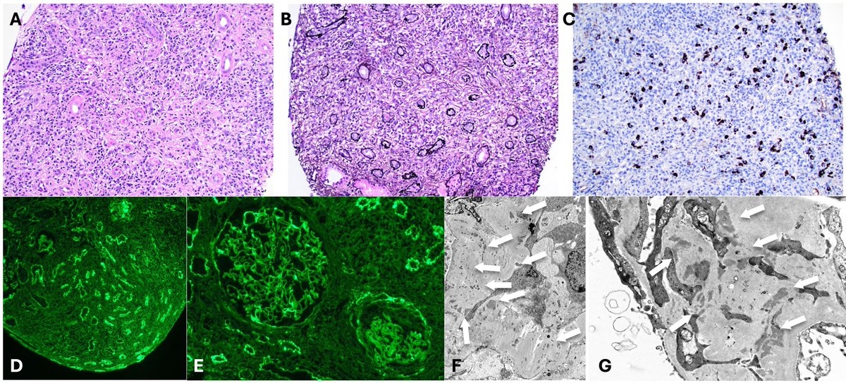 In this article, the authors discuss treatment for IgG4-related kidney disease. bit.ly/CJASN0684
<a href="/AKronbichler/">Andreas Kronbichler</a>
<a href="/n0r0zha/">Noroژa</a> 
<a href="/rahaai/">Amir Abdipour, MD, FASN</a> 
<a href="/SaynaNorouzi/">Sayna Norouzi, MD, FASN</a> 
<a href="/TWhittier_RUSH/">Bill Whittier</a> 
#ASNCJASN