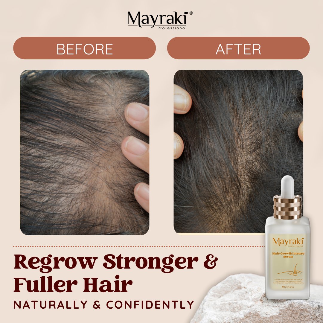 Mayraki4's tweet photo. Before & After Magic ✨📸
Regrow stronger, fuller hair—naturally & confidently! 💪
#mayrakiprofessional #hairmayraki #hairfall #customerlove #hairlosssolution #hairthinning #hairlosstips #thinninghair #hairlosssolutions #hairvolume https://t.co/oKtMe6A4Zc