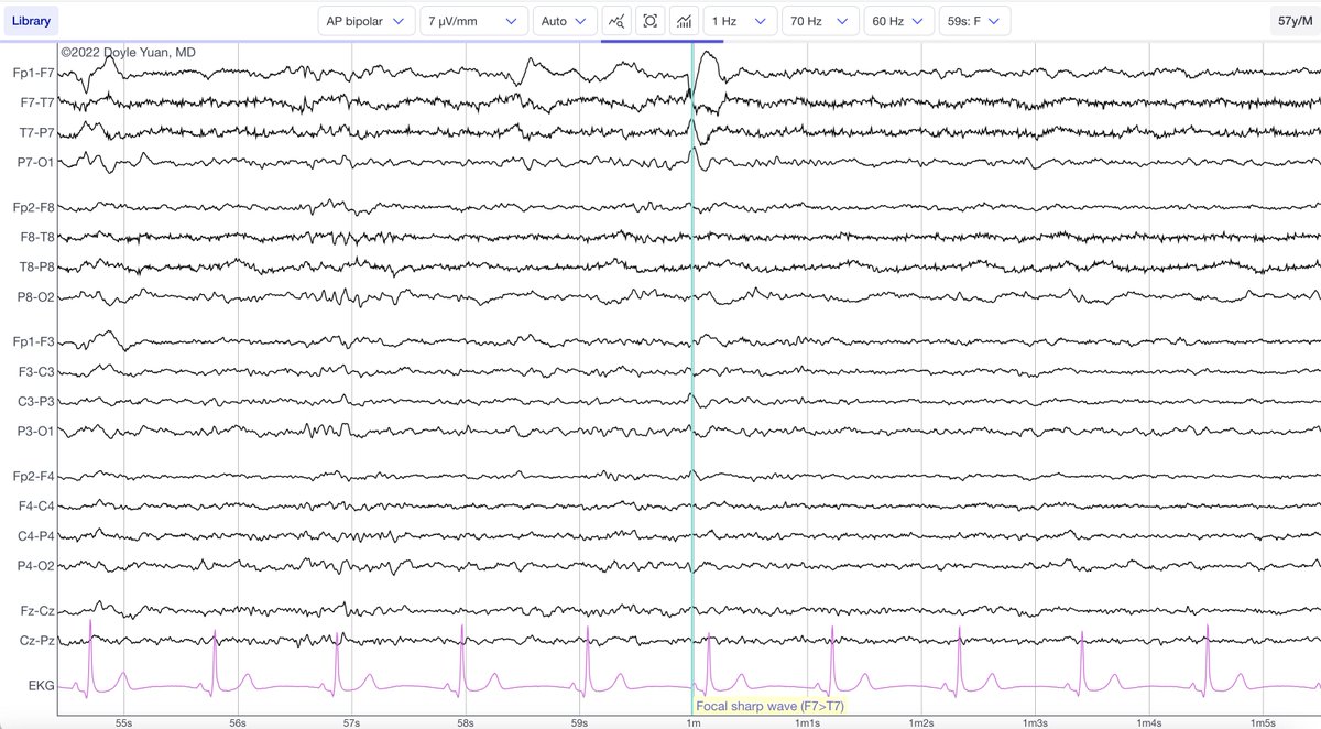 Fábio Nascimento (@fabnascimen) on Twitter photo Big news for #EEGEd! 🚀We’re now featuring real examples on a cutting-edge #EEG viewer built by Dr. Doyle Yuan! 🔥The #KingKong team is taking #EEG education to the next level - are you ready? 💡⚡ eegtalk.com <a href="/RoohiKatyal/">Roohi Katyal</a> <a href="/namesare4babies/">John McLaren, MD 👶🏻🧠⚡️</a> <a href="/SheikhISMD/">irfan sheikh 伊凡</a> <a href="/EEGHub/">EEGHub</a> <a href="/EEGTalk/">EEGTalk</a> Big news for #EEGEd! 🚀We’re now featuring real examples on a cutting-edge #EEG viewer built by Dr. Doyle Yuan! 🔥The #KingKong team is taking #EEG education to the next level - are you ready? 💡⚡ eegtalk.com <a href="/RoohiKatyal/">Roohi Katyal</a> <a href="/namesare4babies/">John McLaren, MD 👶🏻🧠⚡️</a> <a href="/SheikhISMD/">irfan sheikh 伊凡</a> <a href="/EEGHub/">EEGHub</a> <a href="/EEGTalk/">EEGTalk</a>