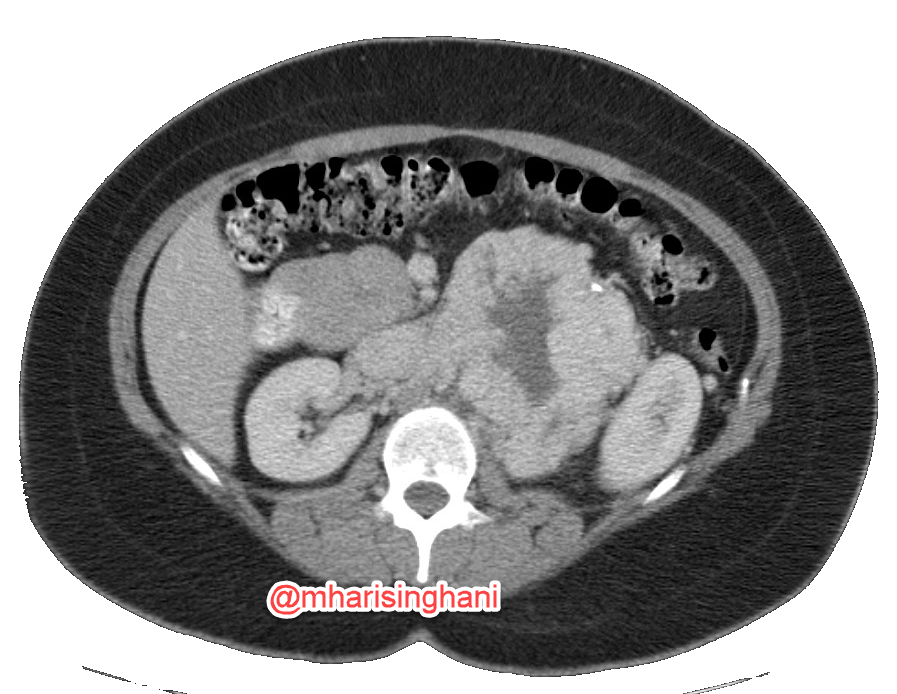 This was a RP paraganglioma