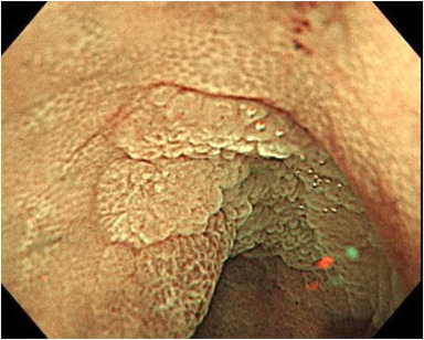 VideoGIE Journal (@videogie) on Twitter photo Mikio Kobayashi et al conduct "Underwater forceps-assisted polypectomy of an appendiceal orifice lesion using a dual-channel gastroscope." videogie.org/article/S2468-…
<a href="/KaraRaphael/">Kara Raphael</a> Mikio Kobayashi et al conduct "Underwater forceps-assisted polypectomy of an appendiceal orifice lesion using a dual-channel gastroscope." videogie.org/article/S2468-…
<a href="/KaraRaphael/">Kara Raphael</a>