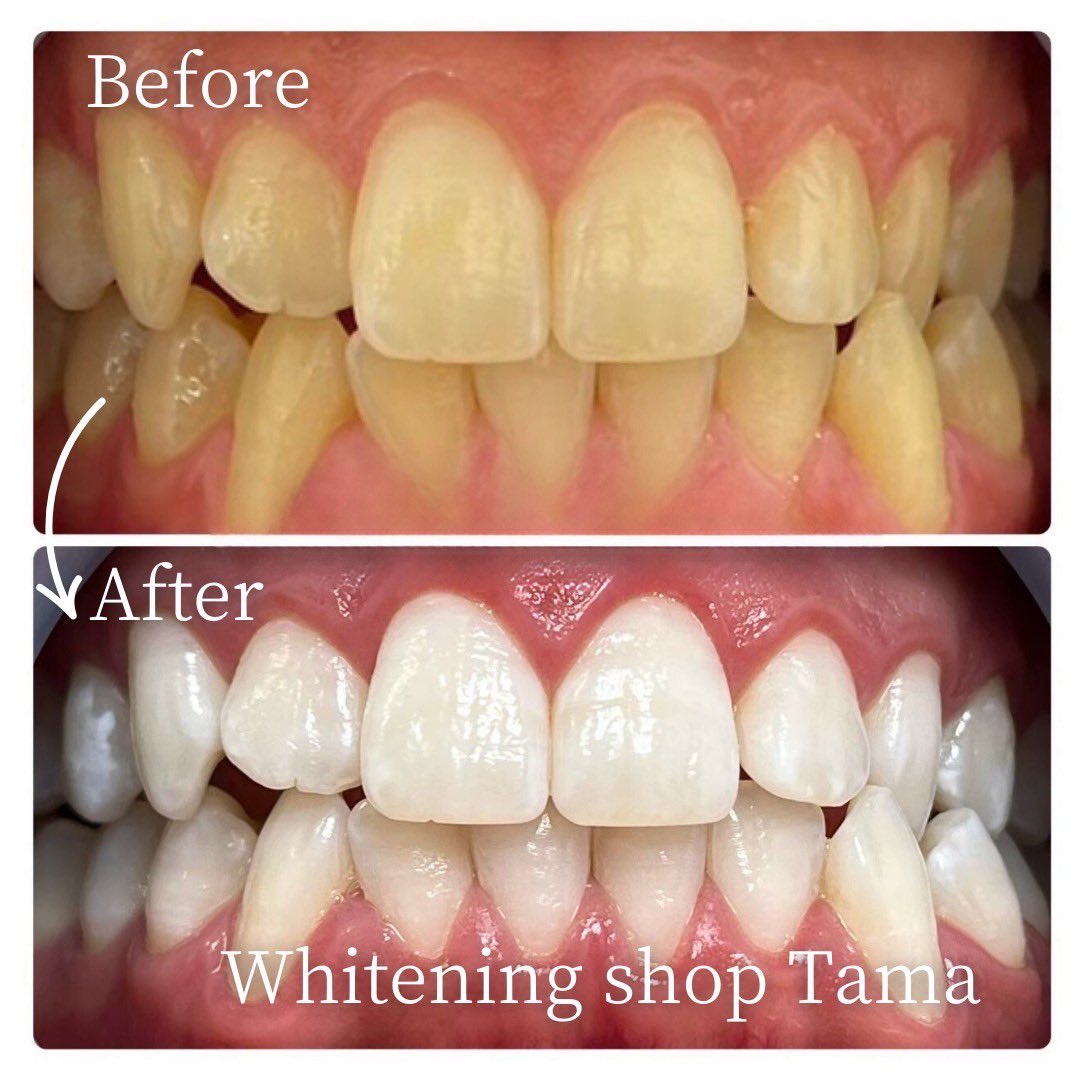 【白い歯の喜びを】

白く美しい歯は、心まで自信を生み出し、人生に健康な笑顔をもたらしてくれます🌟
歯が白く、健康になること、笑顔を増やすことをご提供いたします！

セルフホワイトニングで憧れの白い歯に！
もっと笑顔、もっと前向き、もっと美しく！！💖