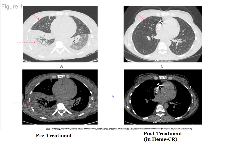 Raj Chakraborty (@rajshekharucms) on Twitter photo Diffuse lung involvement as a rare presentation of systemic AL amyloidosis (15 patients from a collective database of >2000 patients <a href="/unipv/">Università di Pavia</a> & <a href="/columbiacancer/">Herbert Irving Comprehensive Cancer Center</a>)➡️Good organ response achievable after deep hematologic response, and lung transplant was feasible in one patient! Led by Diffuse lung involvement as a rare presentation of systemic AL amyloidosis (15 patients from a collective database of >2000 patients <a href="/unipv/">Università di Pavia</a> & <a href="/columbiacancer/">Herbert Irving Comprehensive Cancer Center</a>)➡️Good organ response achievable after deep hematologic response, and lung transplant was feasible in one patient! Led by