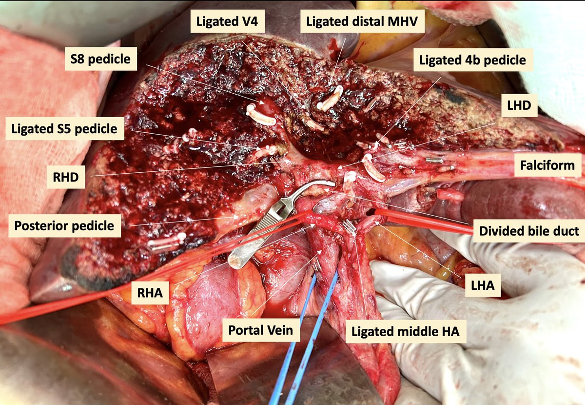 HPB&UGI_ACTREC_TMC (@hpb_ugi_actrec) on Twitter photo Radical Cholecystectomy with bile duct excision for LA GBC, post NACT.
Seg IVb/V anatomical excision provides superior surgical safety and R0 when disease is close to hilum and large liver infiltration.
<a href="/Manishbhandare4/">Manish S Bhandare</a> <a href="/DrGuruduttVarty/">Gurudutt P. Varty</a> <a href="/ACTREC_TMC/">ACTREC-TMC</a> Radical Cholecystectomy with bile duct excision for LA GBC, post NACT.
Seg IVb/V anatomical excision provides superior surgical safety and R0 when disease is close to hilum and large liver infiltration.
<a href="/Manishbhandare4/">Manish S Bhandare</a> <a href="/DrGuruduttVarty/">Gurudutt P. Varty</a> <a href="/ACTREC_TMC/">ACTREC-TMC</a>