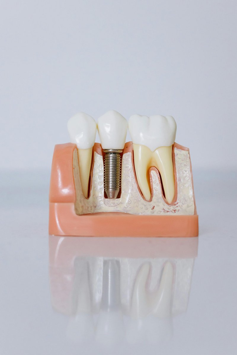 LOS IMPLANTES DENTALES: Todo lo que necesitas saber #Salud #Bucodental #Odontologia  blgs.co/aGFZy0