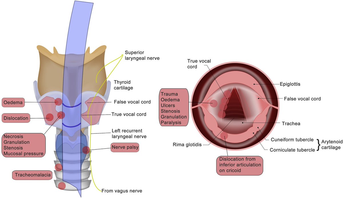 Today's Paper of the Day is:

Laryngeal complications after tracheal intubation and tracheostomy

criticalcarereviews.com/latest-evidenc…

Join us to read 1 paper per day and stay up-to-date as we cover the spectrum of critical care across 2025