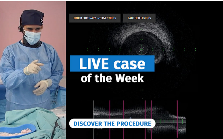 PCRonline 🫀 (@pcronline) on Twitter photo Learn from the replay 📺 of this LIVE educational case:
LAD calcified lesion PCI prepared by rotablator, cutting balloon and IVL
🔗pcronline.com/Cases-resource…
With operators <a href="/HatimLawati/">Hatim Al Lawati</a> and <a href="/adil_jabri/">Adil Al Jabri</a>, and procedural analyst <a href="/twj1974/">Tom Johnson</a>
#CardioEd #GulfPCR #MedEd Learn from the replay 📺 of this LIVE educational case:
LAD calcified lesion PCI prepared by rotablator, cutting balloon and IVL
🔗pcronline.com/Cases-resource…
With operators <a href="/HatimLawati/">Hatim Al Lawati</a> and <a href="/adil_jabri/">Adil Al Jabri</a>, and procedural analyst <a href="/twj1974/">Tom Johnson</a>
#CardioEd #GulfPCR #MedEd