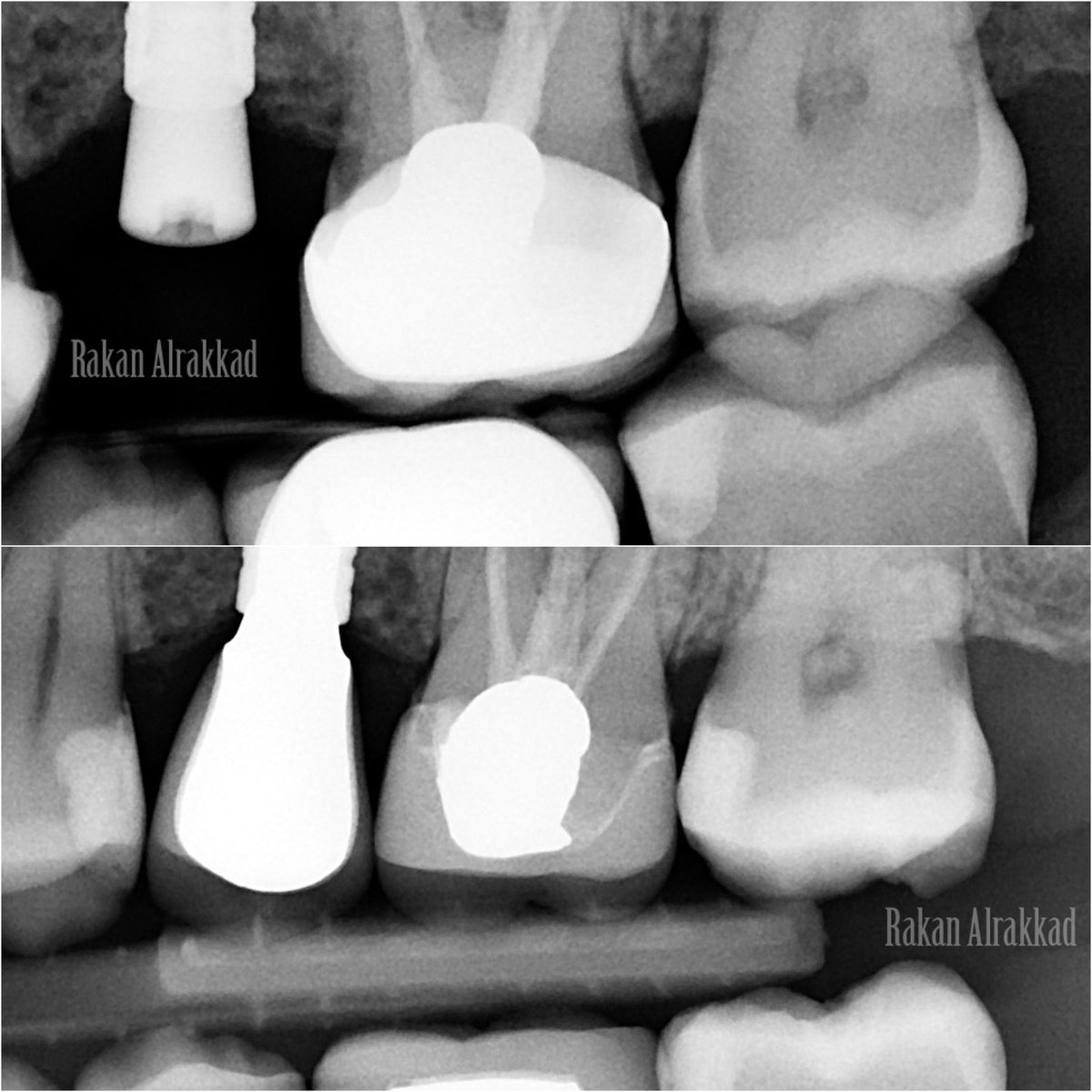حشوة + تركيبة + زراعة ☑️
1st : Restoration for #27
2nd : E-max crown for #26
3rd : Implant supported crown for #25