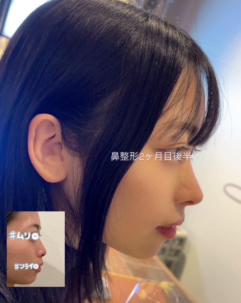 joyhanana's tweet photo. ⚠️鼻整形後の人は絶対チェック⚠️
Drに言われた話まとめました
1.腫れの波は2回来る
2.レティナ・テーピング固定は絶対
3.禁煙！禁酒！禁サウナ！
4.ダメなサプリや食べ物もある
5.傷には清潔・保湿・刺激しないを徹底
#鼻整形  #ダウンタイム 
↓↓詳細は画像↓↓ https://t.co/lH1hewuPeN