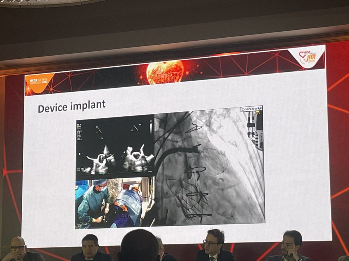 Jonathan Curio (@curiojonathan) on Twitter photo TAVR + LAAO performed by <a href="/Antocol17/">Antonio Colombo</a> <a href="/AntonioMangieri/">antonio mangieri</a> at #JIMGISE2025 <a href="/jimcongress/">JIM Congress</a>⭐️
🎯patient w/ Hb-dropping GI bleeding on DOAC
🎯combined procedure will increase patient comfort
➡️w/ established + standardized procedures available streamlined combination possible TAVR + LAAO performed by <a href="/Antocol17/">Antonio Colombo</a> <a href="/AntonioMangieri/">antonio mangieri</a> at #JIMGISE2025 <a href="/jimcongress/">JIM Congress</a>⭐️
🎯patient w/ Hb-dropping GI bleeding on DOAC
🎯combined procedure will increase patient comfort
➡️w/ established + standardized procedures available streamlined combination possible