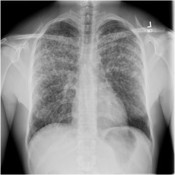 AJKD (@ajkdonline) on Twitter photo Quiz: Young man with 1 week of fever, headaches, nonproductive cough, 1 day of dyspnea. Within 36 hours, he had 1 episode of hemoptysis and worsening hypoxia requiring mechanical ventilation.
bit.ly/3QvWcGC (FREE)
<a href="/Joyita_4/">Joyita Bharati</a> <a href="/MikeBaldino90/">MikeBaldino</a> <a href="/asupadh/">Ashish Upadhyay</a> <a href="/bu_bmc_renal/">BU/BMC Section of Nephrology</a> Quiz: Young man with 1 week of fever, headaches, nonproductive cough, 1 day of dyspnea. Within 36 hours, he had 1 episode of hemoptysis and worsening hypoxia requiring mechanical ventilation.
bit.ly/3QvWcGC (FREE)
<a href="/Joyita_4/">Joyita Bharati</a> <a href="/MikeBaldino90/">MikeBaldino</a> <a href="/asupadh/">Ashish Upadhyay</a> <a href="/bu_bmc_renal/">BU/BMC Section of Nephrology</a>