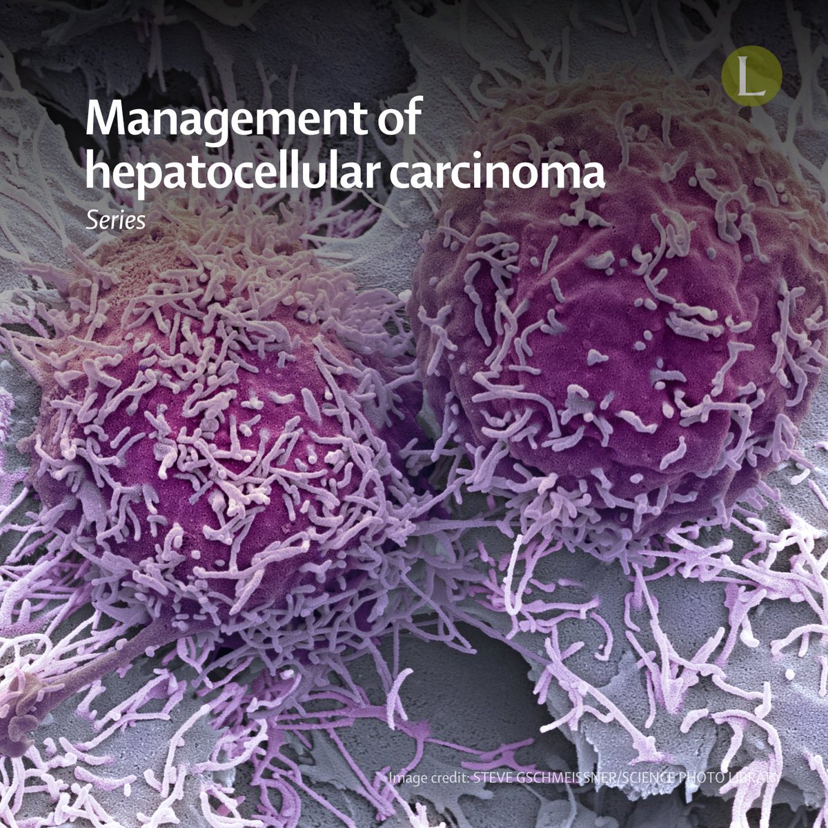 The Lancet (@thelancet) on Twitter photo The treatment of hepatocellular carcinoma is complex, with diverse therapeutic approaches and the need to navigate the underlying liver disease.
A new Series in <a href="/LancetGastroHep/">The Lancet Gastroenterology & Hepatology</a> explores 3 key areas in the modern management of hepatocellular carcinoma: hubs.li/Q0374zY00 The treatment of hepatocellular carcinoma is complex, with diverse therapeutic approaches and the need to navigate the underlying liver disease.
A new Series in <a href="/LancetGastroHep/">The Lancet Gastroenterology & Hepatology</a> explores 3 key areas in the modern management of hepatocellular carcinoma: hubs.li/Q0374zY00