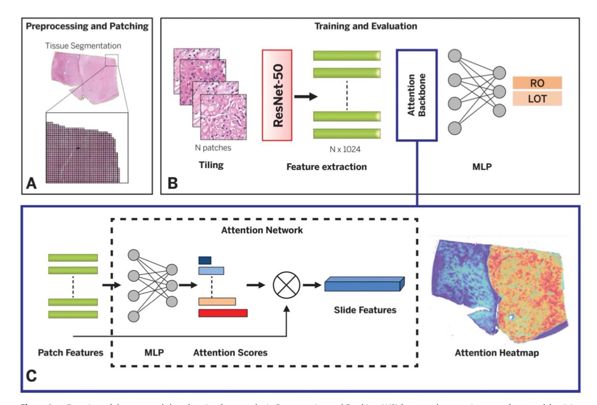 Katrina Collins, MD || Pathologist (@katcollmd) on Twitter photo 🚨 #publicationalert #gupath
Together with <a href="/innani8/">Shubham Innani</a>, we developed a DL-based classifier to distinguish RO from LOT in WSI with high accuracy.
<a href="/ArchivesPath/">Arch Pathol Lab Med</a> <a href="/iupathology/">IUPathology</a> <a href="/IUCompPath/">IU Division of Computational Pathology</a>
🔗 doi.org/10.5858/arpa.2… 🚨 #publicationalert #gupath
Together with <a href="/innani8/">Shubham Innani</a>, we developed a DL-based classifier to distinguish RO from LOT in WSI with high accuracy.
<a href="/ArchivesPath/">Arch Pathol Lab Med</a> <a href="/iupathology/">IUPathology</a> <a href="/IUCompPath/">IU Division of Computational Pathology</a>
🔗 doi.org/10.5858/arpa.2…