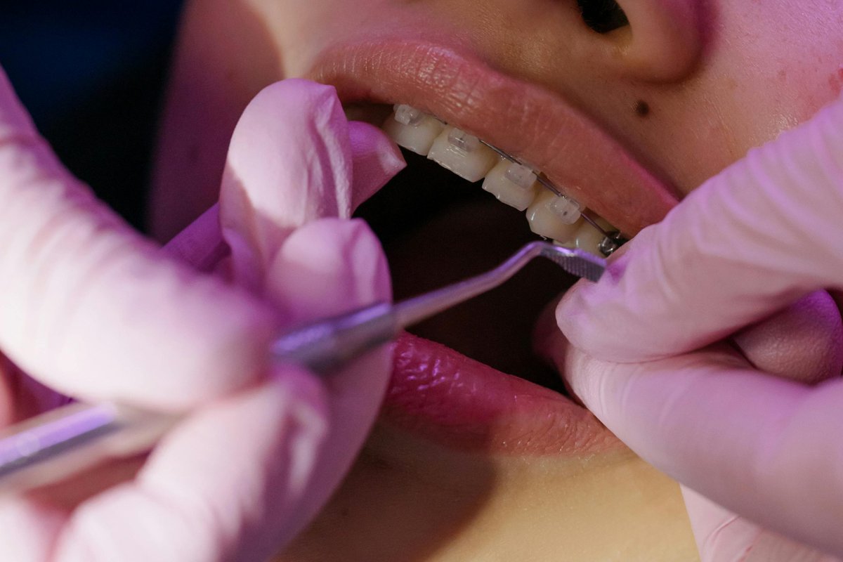 BRACKETS INVISIBLES DE ZAFIRO: la opción estética y resistente para tu ortodoncia #Salud #Bucodental #Odontologia  blgs.co/JX1JlS