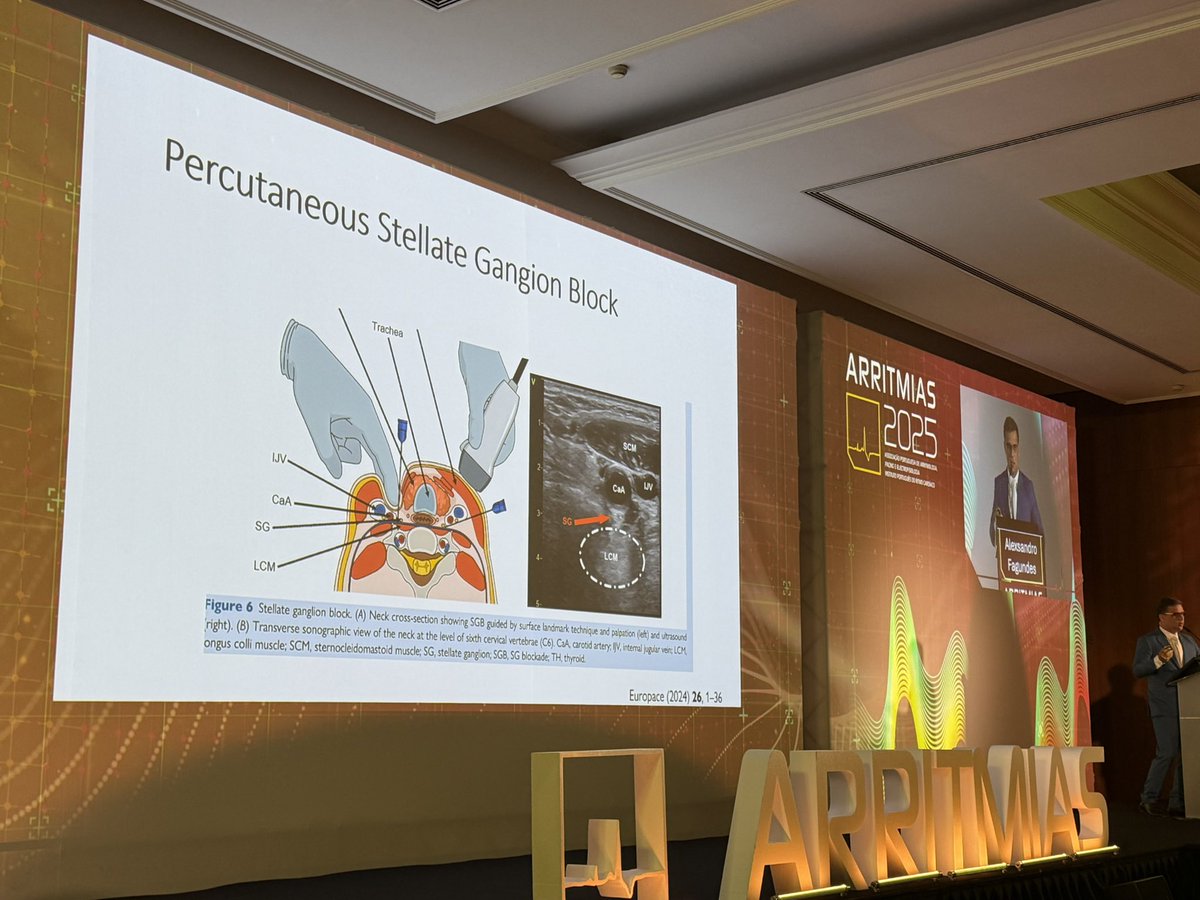 Francisco M. Costa (@moscoso_costa) on Twitter photo Joint session <a href="/SobracO/">SOBRAC</a> / <a href="/APAPEletro/">APAPE</a> during #ARRITMIAS2025
Discussing VT storm treatment with our Brazilian friends <a href="/crpisani/">Cristiano Pisani</a> <a href="/AlexsandroFag18/">Alexsandro Fagundes</a> <a href="/cavaco_diogo/">Diogo Cavaco</a> <a href="/cortezdias/">Nuno Cortez-Dias, MD PhD</a> <a href="/spcardio/">Sociedade Portuguesa de Cardiologia</a> Joint session <a href="/SobracO/">SOBRAC</a> / <a href="/APAPEletro/">APAPE</a> during #ARRITMIAS2025
Discussing VT storm treatment with our Brazilian friends <a href="/crpisani/">Cristiano Pisani</a> <a href="/AlexsandroFag18/">Alexsandro Fagundes</a> <a href="/cavaco_diogo/">Diogo Cavaco</a> <a href="/cortezdias/">Nuno Cortez-Dias, MD PhD</a> <a href="/spcardio/">Sociedade Portuguesa de Cardiologia</a>