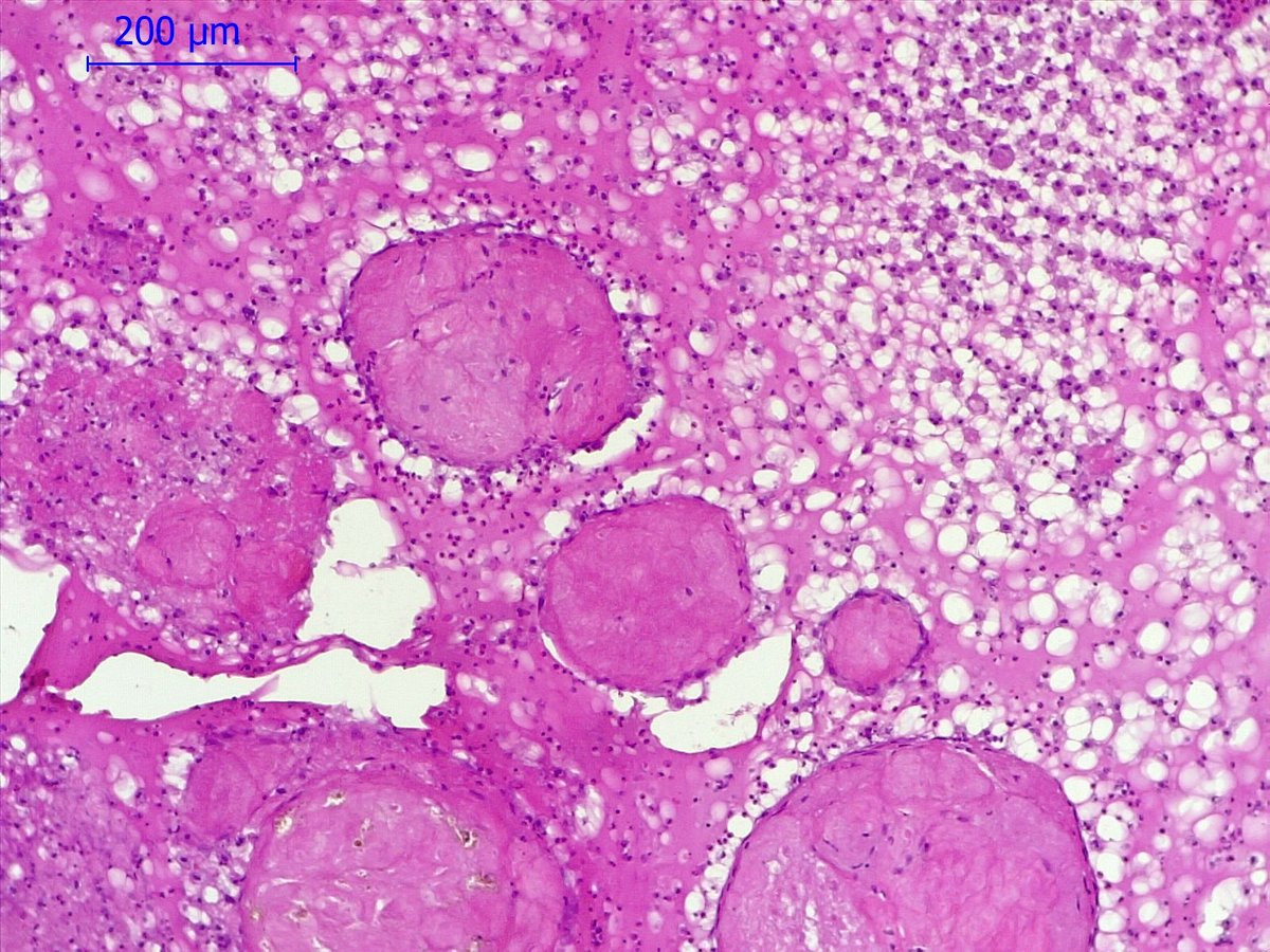 Silvia Carino (@oralpathologyok) on Twitter photo Mucocele : Classic, Superficial, organized. Bonus track w/mixoglobulosis. Inspirada en mi amig🌹 <a href="/ariella8/">Celina Stayerman MD</a> #oralpath Mucocele : Classic, Superficial, organized. Bonus track w/mixoglobulosis. Inspirada en mi amig🌹 <a href="/ariella8/">Celina Stayerman MD</a> #oralpath