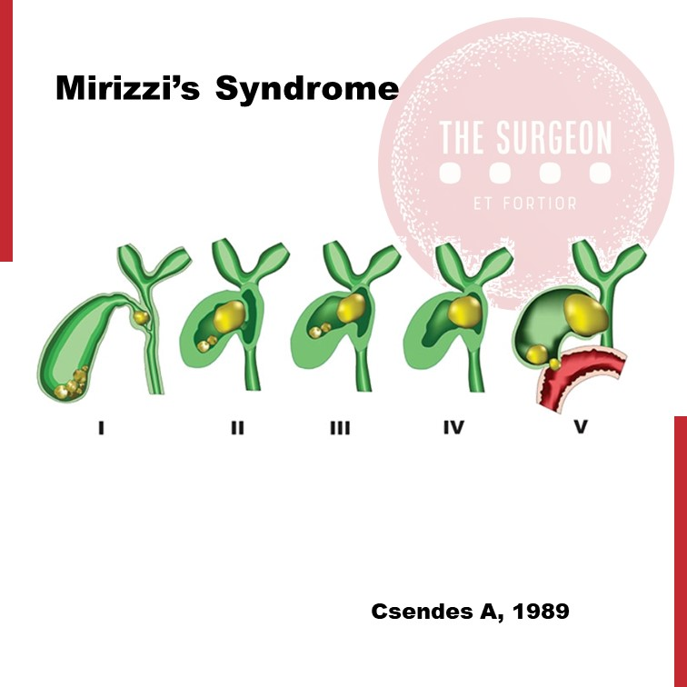 📊 Mirizzi's Syndrome Classification

Types I-V: Progressive compression of biliary tract

Type I: External compression
Type II: Fistula &lt;⅓ duct diameter
Type III: Fistula &gt;⅔ duct diameter
Type IV: Complete wall destruction
Type V: Complex with cholecystoenteric fistula