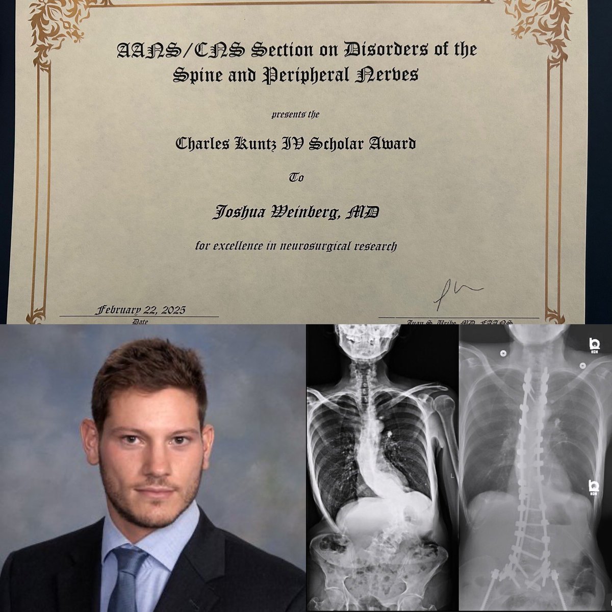 Ohio State Neurosurgery Residency (@neurosurgeryosu) on Twitter photo Congratulations to <a href="/WeinbergJH/">Joshua H. Weinberg, MD</a>, one of our PGY4 residents doing our clinical research track, on winning the Charles Kuntz IV Scholar Award at the 2025 <a href="/spinesection/">AANS/CNS Spine Section</a> annual meeting! Congratulations to <a href="/WeinbergJH/">Joshua H. Weinberg, MD</a>, one of our PGY4 residents doing our clinical research track, on winning the Charles Kuntz IV Scholar Award at the 2025 <a href="/spinesection/">AANS/CNS Spine Section</a> annual meeting!
