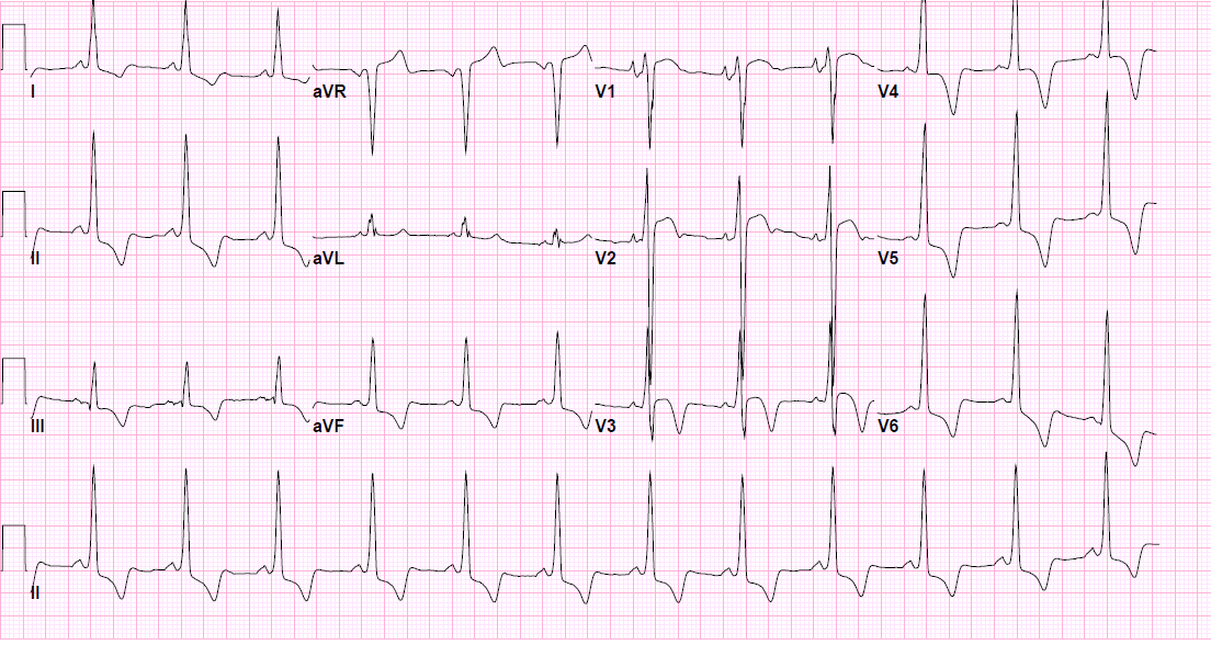 IhabFathiSulima's tweet image. A 32 Male with 
H/O Sudden Cardiac death in Family.
C/O SOB 
ECHO showed asymmetrical Hypertrophy.
MRI is shown +ECG 
Diagnosis ?
#WPW_SYNDROME.
#Hypertrophic_Cardiomyopathy.
#Brugada_syndrome.
#WPW and #HCM