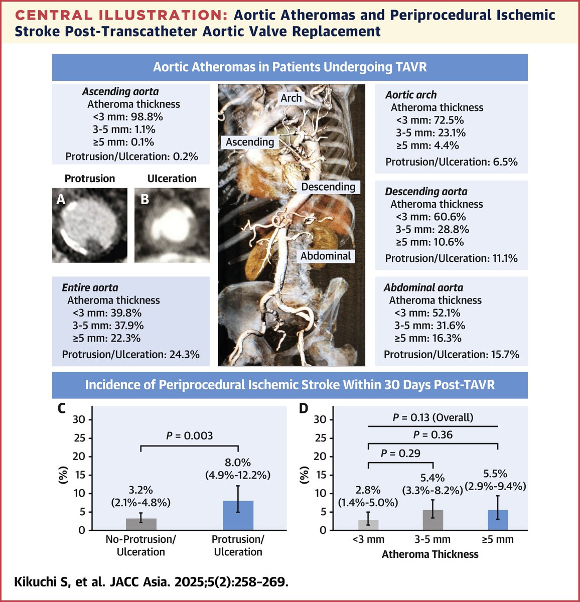JACC Journals (@jaccjournals) on Twitter photo Protruding or ulcerated aortic atheromas, especially in the aortic arch, ⬆️ the risk of periprocedural ischemic #stroke post-TAVR. Careful procedural planning & valve selection are critical for these pts jacc.org/doi/10.1016/j.… #JACCAsia #TAVR #cvVHD <a href="/BMarchandot/">Benjamin Marchandot</a> <a href="/A_Trimaille/">Antonin Trimaille</a> Protruding or ulcerated aortic atheromas, especially in the aortic arch, ⬆️ the risk of periprocedural ischemic #stroke post-TAVR. Careful procedural planning & valve selection are critical for these pts jacc.org/doi/10.1016/j.… #JACCAsia #TAVR #cvVHD <a href="/BMarchandot/">Benjamin Marchandot</a> <a href="/A_Trimaille/">Antonin Trimaille</a>