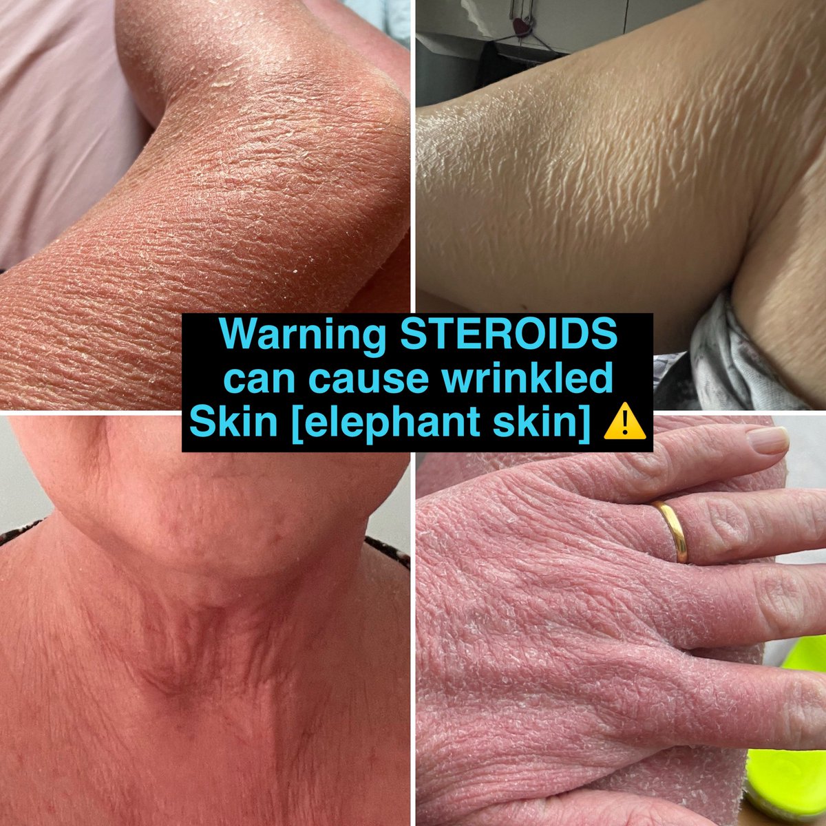 MYTSWWORLD's tweet photo. @Fluppfluppflupo @LexiluMaximoo @FondOfBeetles Yes steroid withdrawal is real. https://t.co/FTKj9bs1W0