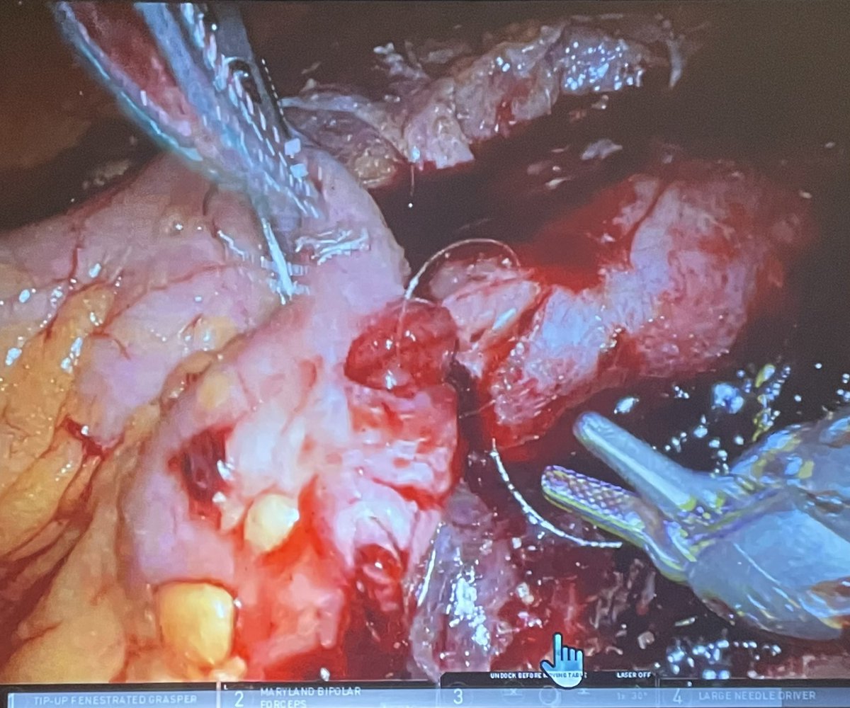 Ricardo Soares (@soares_uro) on Twitter photo Ileal ureter for ureteral avulsion by our own <a href="/ZLeeGU/">Ziho Lee</a> <a href="/NM_Urology/">NM Urology</a>
- Early repair: avoid fibrosis; able to use UPJ/ ureteral stump instead of calycostomy
- ileum in anti-peristaltic orientation to optimize blood supply
- UPJ sutured conduit-style to ileum
<a href="/RoboUro/">North American Robotic Urology Society | NARUS</a> #narus2025 Ileal ureter for ureteral avulsion by our own <a href="/ZLeeGU/">Ziho Lee</a> <a href="/NM_Urology/">NM Urology</a>
- Early repair: avoid fibrosis; able to use UPJ/ ureteral stump instead of calycostomy
- ileum in anti-peristaltic orientation to optimize blood supply
- UPJ sutured conduit-style to ileum
<a href="/RoboUro/">North American Robotic Urology Society | NARUS</a> #narus2025