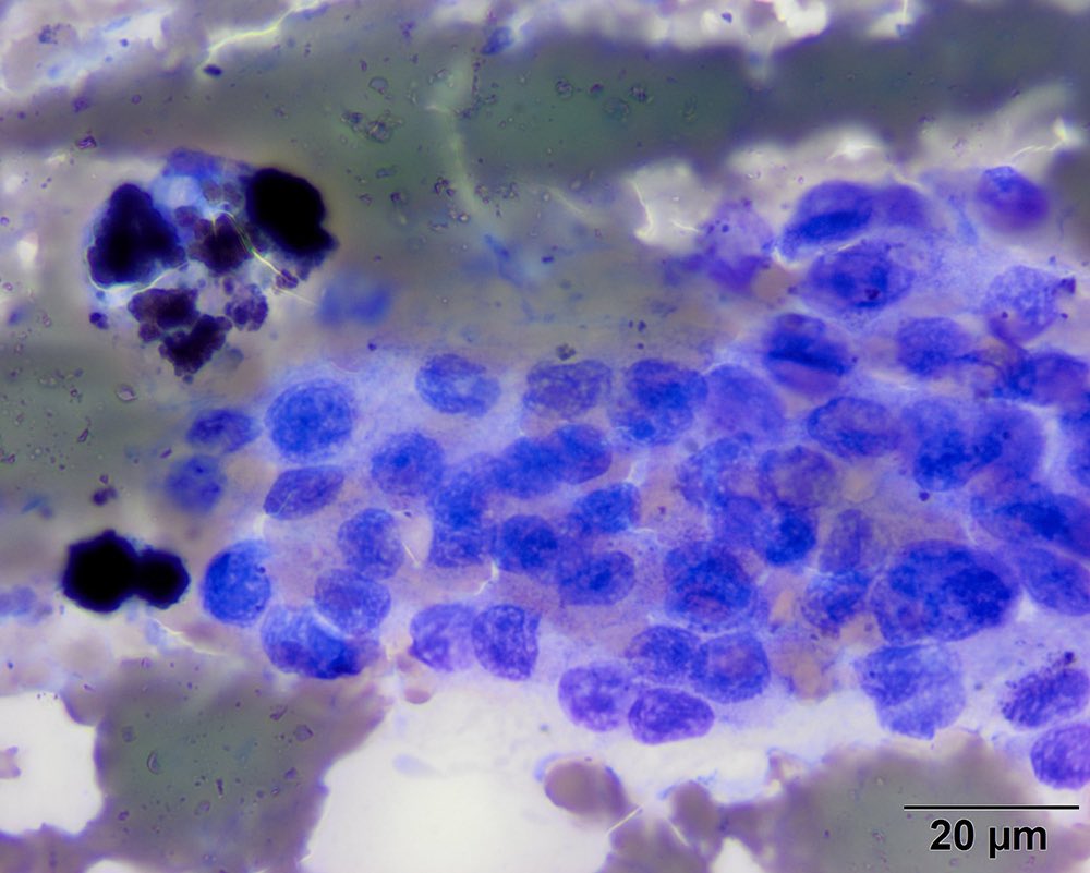 Our latest diagnostic challenge: Aspirate of a mass at the thoracic inlet in a hypercalcemuc horse. For the full case go to eclinpath.com/case-1-2025/