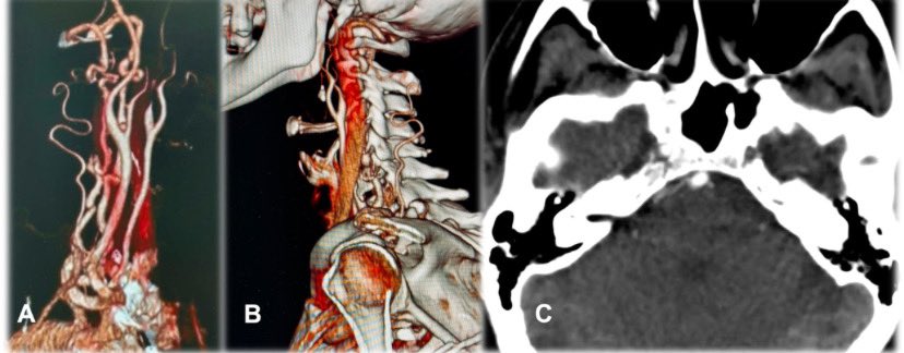 Internal Carotid Artery Hypoplasia: A Case Report

March 2025

sciencedirect.com/science/articl…