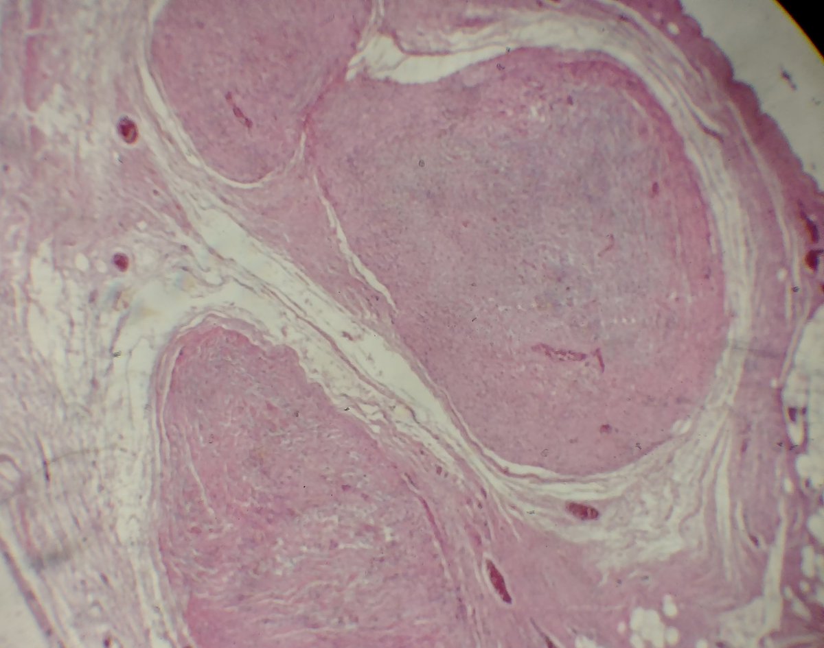 9_montero's tweet photo. Neurofibroma plexiforme
#tejidoblando#softtissue#benigno#nervioperiferico https://t.co/NcjxVVijoB