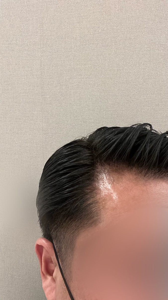 おはようございます。

人生初･理容室で白髪染めいたしました。
これまで自己で染めてましたが、染めムラが多く…。😅

プロにお任せするとここまでキレイに染まるのですね🤣

白髪染➕カット･髭剃り･襟剃り･洗髪･セットで3,850円‼️お手頃価格の大満足です。