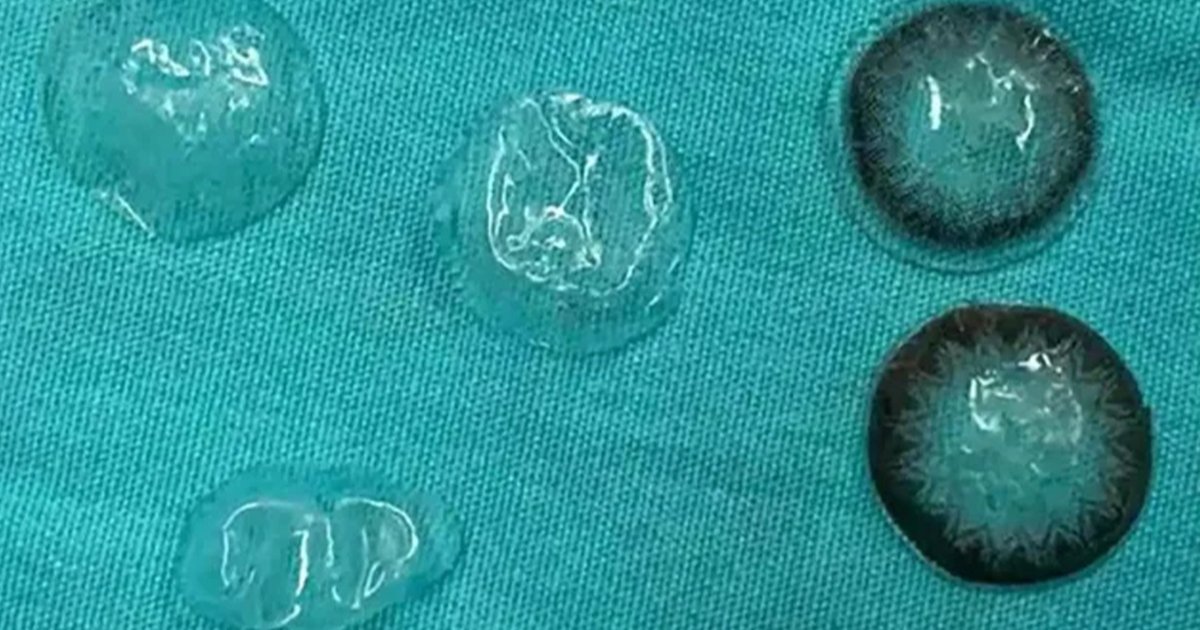 viralchai's tweet photo. Doctors Warn After Finding Five Contact Lenses Stuck In Woman’s Eye https://t.co/EcRJVVBX4c https://t.co/Euh3W88w2K