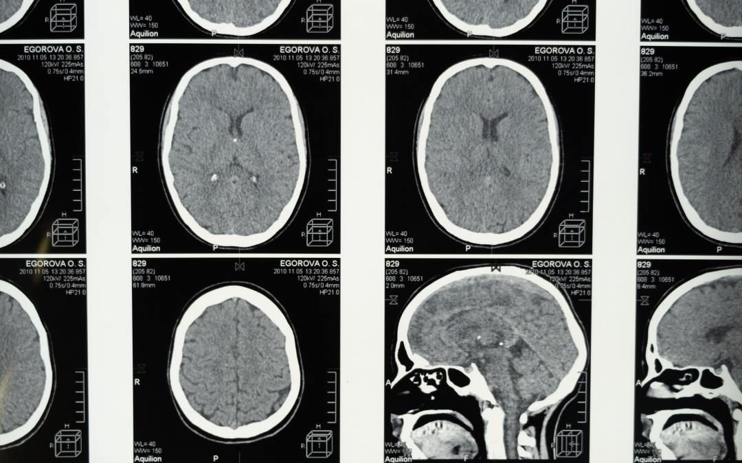 The vagus nerve supports the regulation of the internal viscera, including the heart, and can be compromised in the aftermath of psychological trauma.
This article examines the clinical strategies for treating vagus nerve impairments in trauma survivors. buff.ly/39uJndr
