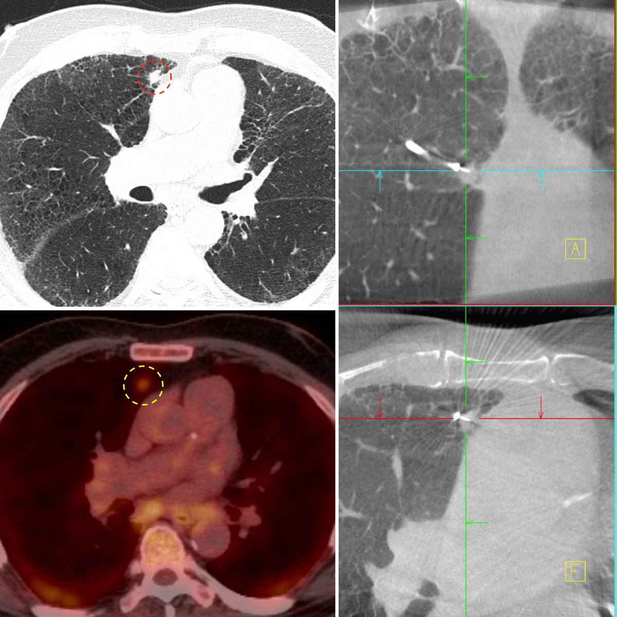 Making the impossible routine!
Shape sensing robotic assisted bronchoscopy, combined with live 3D imaging, allows for unlikely navigational biopsies to become average procedures.

Whether the difficulty is size (6mm nodule), location (above aortic arch), structure (cystic rim),