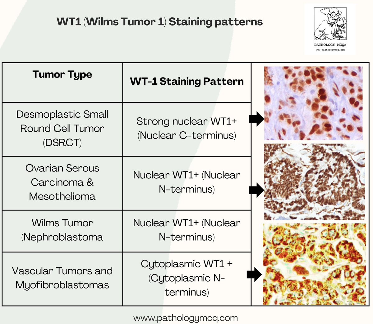 WT1 Staining Patterns: Why Location Matters!

WT1 expression varies across tumors—nuclear C-terminal WT1+ in DSRCT, nuclear N-terminal WT1+ in serous carcinoma &amp; Wilms tumor, and cytoplasmic WT1+ in vascular tumors &amp; myofibroblastomas.